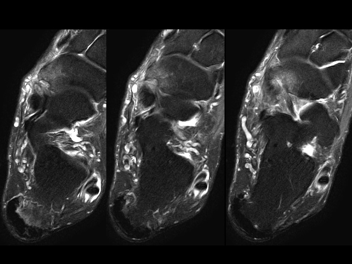 Figure 2 for case posterior tibial tendon ( RID3194 )